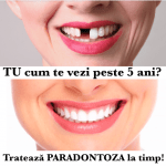 parodontoza