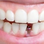 Implant dentar
