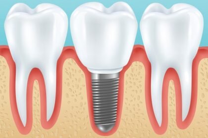 implant dentar