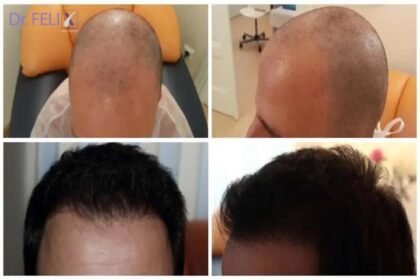 reconstructie-capilara-dr-felix-hair-implant