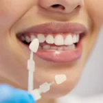 fatete-dentare-zirconiu