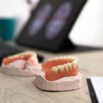 dantura-all-on-4-sau-all-on-6