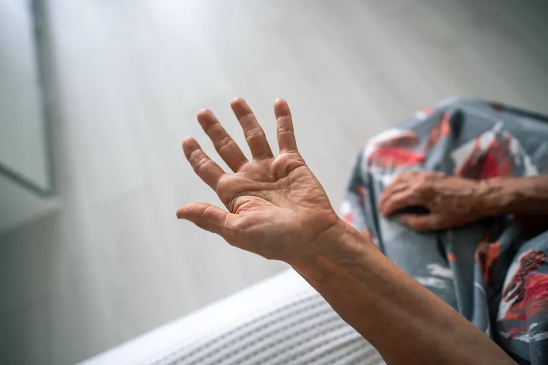 degetele-tale-nu-se-mai-ndreapt-complet-afl-dac-este-vorba-de-maladia-dupuytren