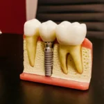 5-lucruri-pe-care-este-bine-sa-le-stii-despre-un-implant-dentar-straumann