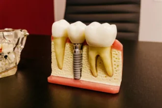 5-lucruri-pe-care-este-bine-sa-le-stii-despre-un-implant-dentar-straumann