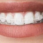 aparat dentar