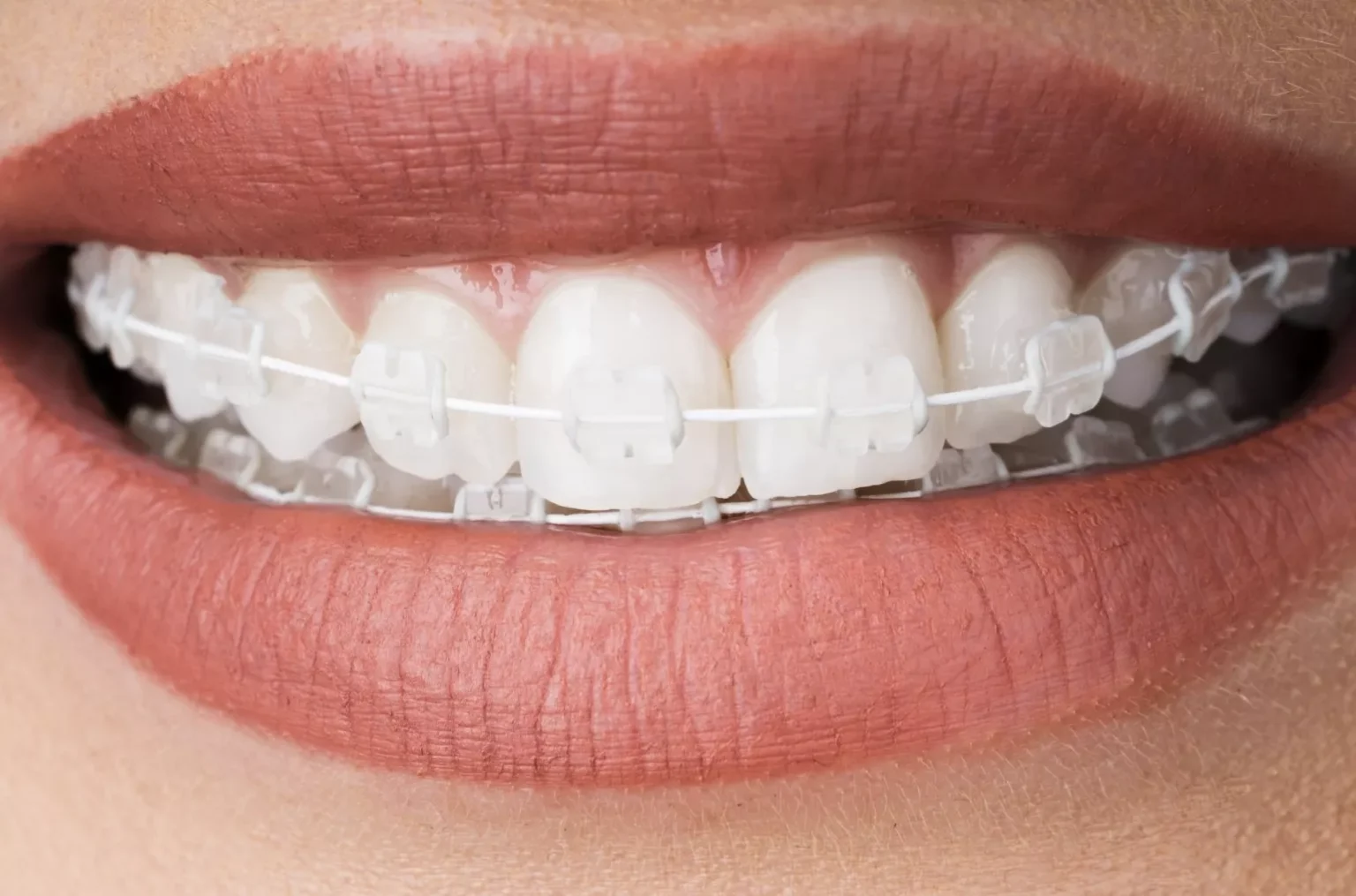 aparat dentar