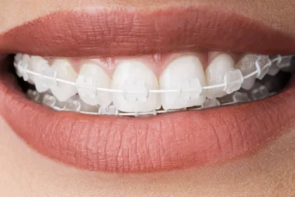 aparat dentar