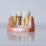 implantul-dentar-cu-laser-cat-dureaza-recuperarea-de-fapt