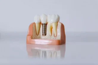 implantul-dentar-cu-laser-cat-dureaza-recuperarea-de-fapt
