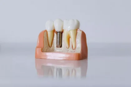 implantul-dentar-cu-laser-cat-dureaza-recuperarea-de-fapt