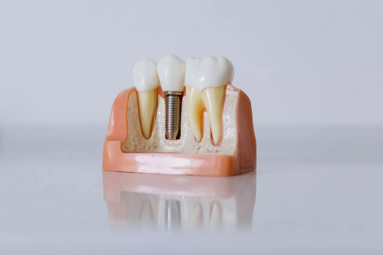 implantul-dentar-cu-laser-cat-dureaza-recuperarea-de-fapt
