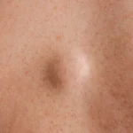 lipom